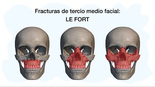 FRACTURAS LE FORT 💀✅ [upl. by Laban]