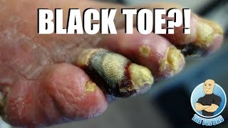 GANGRENE TOE ON A DIABETIC PATIENT [upl. by Kingsly190]