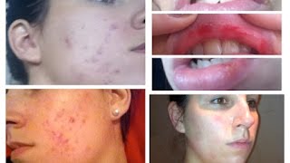 acné le roaccutane les boutons  comment traiter  The Beauty Progress [upl. by Nancey90]