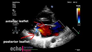 Myxomatous mitral valve degeneration MMVD posterior leaflet mitral regurgitation echocardiography [upl. by Ennovahs]