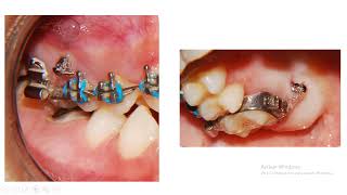 ¿Cómo es la intrusión molar en Ortodoncia y mini tornillos CUANDO UNA MUELITA SE SALE DEL HUESO 👍 [upl. by Mloc]