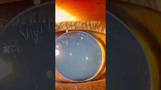 Anterior dislocation of microspherophakic lens eyehealthmatters optometrist ophthalmologists [upl. by Noremac]