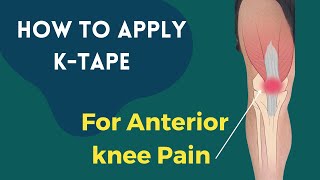 How to treat Knee Pain Patellofemoral Pain syndrome using Kinesiology tape [upl. by Lavud]