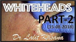 ANTI ACNE TREATMENT PART2 BY DRLALIT KASANA15082018 [upl. by Hafler23]