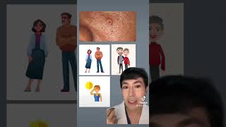 How to treat Sebaceous Gland Hyperplasia [upl. by Eulaliah755]