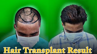 Fue Hair Transplant Result  Kolkata  Dr Jayanta Bain plastic surgeon [upl. by Teryn]