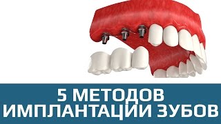 Имплантация зубов 5 методов имплантации зубов [upl. by Aidnyl]