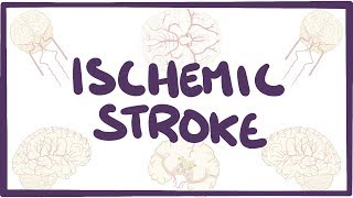 Ischemic Stroke  causes symptoms diagnosis treatment pathology [upl. by Kcered]