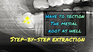 When the Mesial Root is Stuck Step by Step Wisdom Tooth Extraction Video with Instruments Listed [upl. by Carmon809]