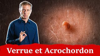 Utilisez liode pour les acrochordons et les verrues l Dr Eric Berg [upl. by Noval]