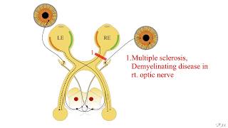 Pupillary light reflex [upl. by Berlyn]