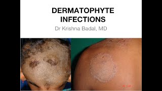 Dermatophyte infections of Skin [upl. by Kuehnel]