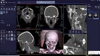 Define Vessels  Curved SIEMENS CT SOMARIS X or 10شرح السوفت وير الأشعه المقطعيه سيمنس [upl. by Eednar]