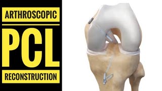 Arthroscopic PCL Posterior Cruciate LigamentReconstruction with Hamstring Graft [upl. by Ehc423]