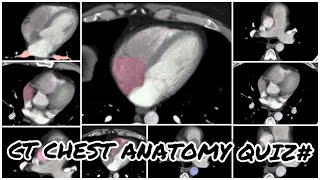 CT SCAN CHEST ANATOMICAL QUIZ [upl. by Ciardap]