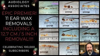 1 HR11 EAR WAX REMOVALS [upl. by Bacon]