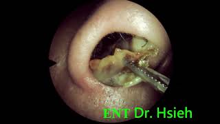 ENT local treatment after RT 3 weeks 010 鼻中膈鼻道成形手術術後三週耳鼻喉局部治療 [upl. by Ahsilif]