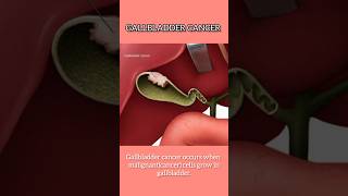 Gall bladder Cancer I Treatment for Gall bladder cancer in Delhi [upl. by Erminie407]