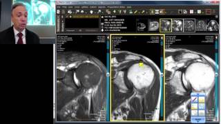 MRI Case Review Shoulder Deep Dive [upl. by Onaivlis350]