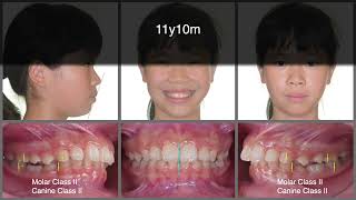 Solving Overjet and Deepbite with Aligners  Part 1｜【Chris Chang Ortho】CC819 [upl. by Emerej]