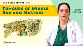 Tumours of Middle Ear and Mastoid  ENT Video Lecture  Doctors VLearning [upl. by Woolson]