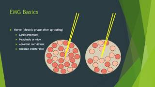 Neuropathy vs myopathy on EMG [upl. by Barnaba]