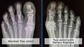 Causes and Treatment of Pain in the Big Toe Joint [upl. by Hait]