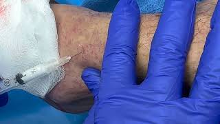 How We Safely Inject Liquid amp Foam Sclerotherapy into Ankle amp Foot Veins [upl. by Buck631]