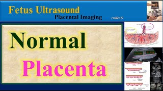 Fetus Ultrasound  Normal Placenta [upl. by Boot169]