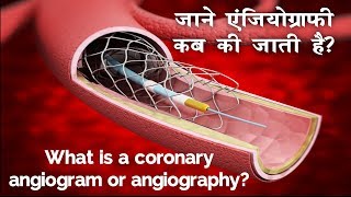 दिल की नसों का हाल जानने के लिए किया जाने वाल टेस्ट एंजियोग्राफी  Angiography in Hindi [upl. by Annyahs]