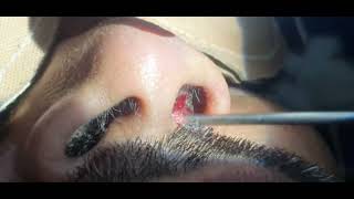 Nose abscess  Nose furuncle  Incision and drainage  Dr Hitesh Patel [upl. by Annhoj166]