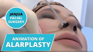 ANIMATION OF ALARPLASTY  DR TANVEER JANJUA  NEW JERSEY [upl. by Coheman277]