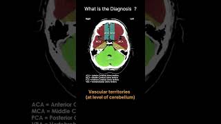 Vascular territories  at level of cerebellum CT Brain Anatomy Quiz 34 radiologychannel007 [upl. by Aneelehs]