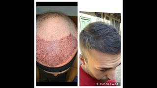 3 mesi dopo il mio trapianto di capelli fatto in Turchia i primi risultati Post operatorio [upl. by Enecnarf854]