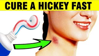 How to Get Rid of a Love Bite HICKEY Naturally [upl. by Trubow]