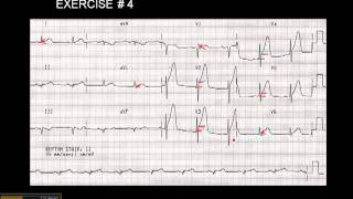 1215 Lead ECG Exercise  4 [upl. by Assilac]