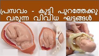 Stages of Delivery Malayalam  Normal Delivery step by step [upl. by Ydde978]