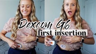 MY FIRST DEXCOM G6 SENSOR INSERTION  my reaction [upl. by Luane]