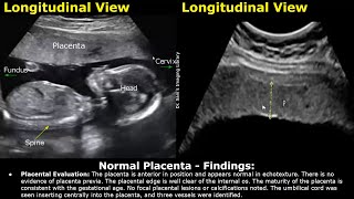 Placenta Ultrasound Reporting  How To Write Pregnancy USG Reports  Pathologies amp Positions Scans [upl. by Alcot]