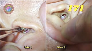 Professional earwax removal Episode 171 [upl. by Leind]