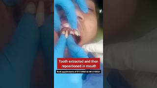 Tooth knocked out of place put back in position Tooth Avulsion Dr Srishti Bhatia [upl. by Bullock688]