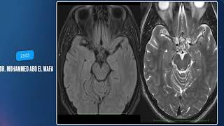 Clinicalradiological MS syndromes at the Brainstem Arabic [upl. by Haras]