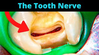 Tooth Cavity  Partial Pulpotomy Procedure Healed Without a Root Canal  Dr Ricucci [upl. by Moriah222]