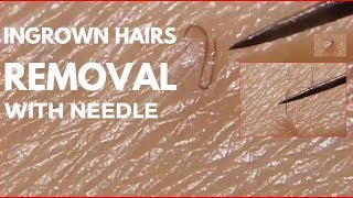 Ingrown hairs removal with needle [upl. by Yusuk]