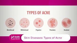 Types of Acne [upl. by Fortin]