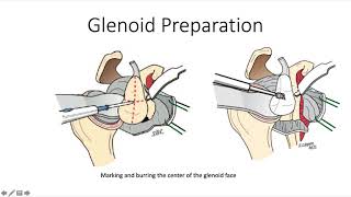 How To Do a Reverse Total Shoulder 3 Glenoid Preparation and Insertion [upl. by Tnek]