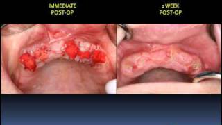 MANDIBULAR IMPLANT OVERDENTURE FABRICATION [upl. by Anny]