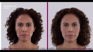 Sculptra Patient Testimonial Marina’s Experience with CollagenBoosting Treatment [upl. by Elga]