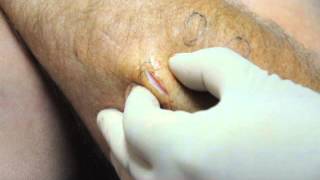 How to remove lipoma in 30 seconds [upl. by Sauveur]