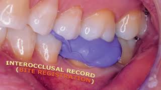 bite registeration  inter occlusal record [upl. by Erikson]